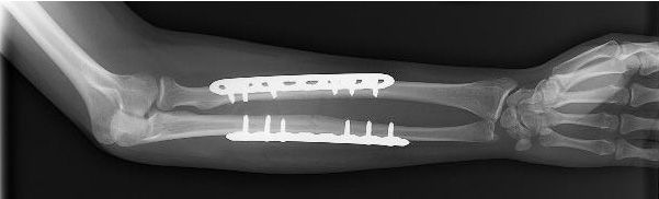 internal fixation of forearm fracture