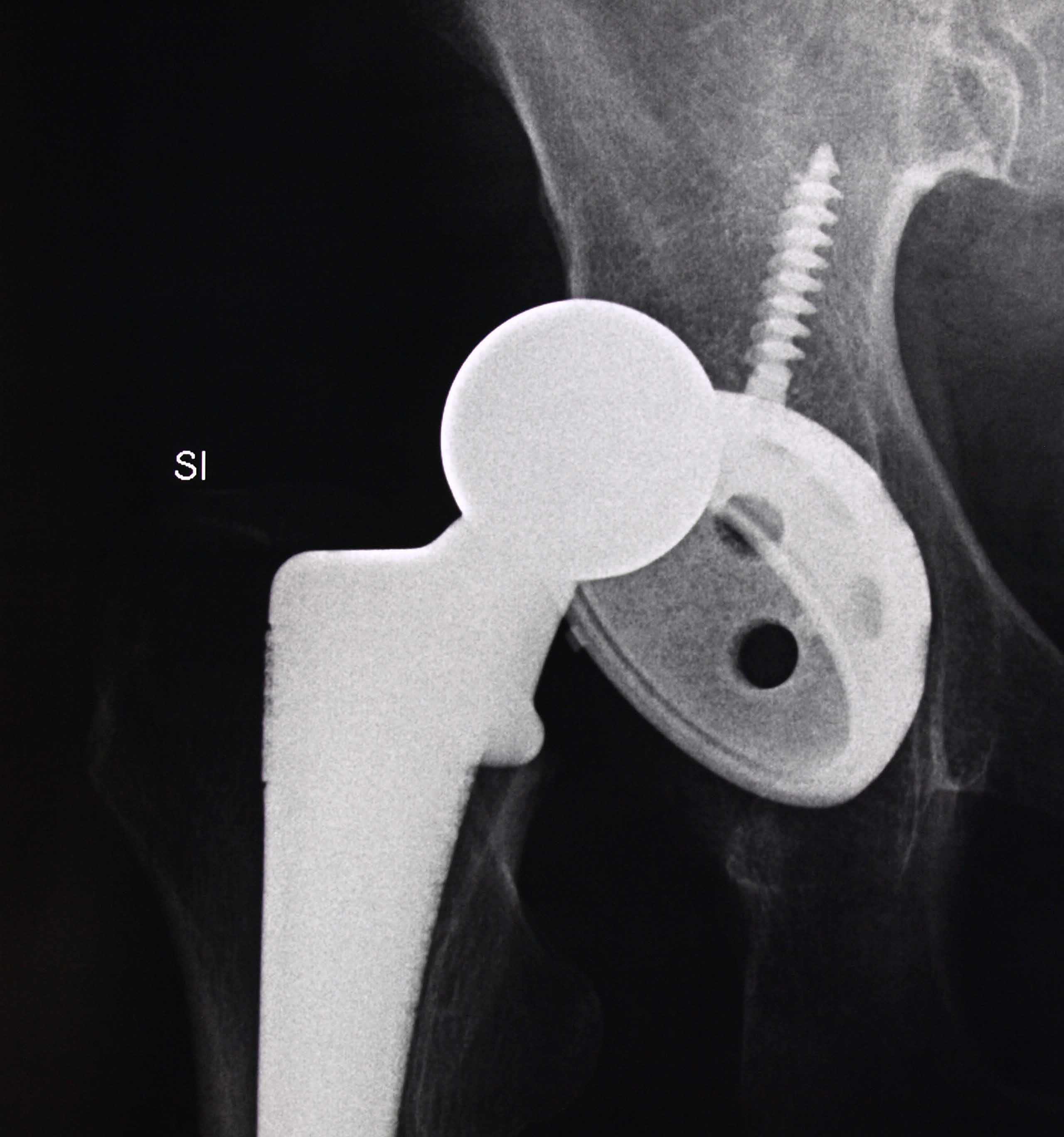 Dislocation After Hip Replacement