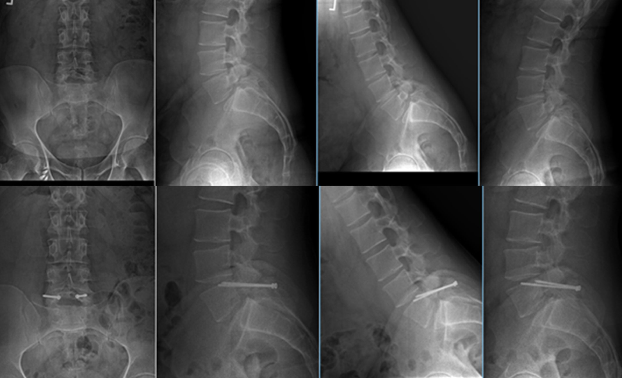 X-rays showing patient before and after pars repair