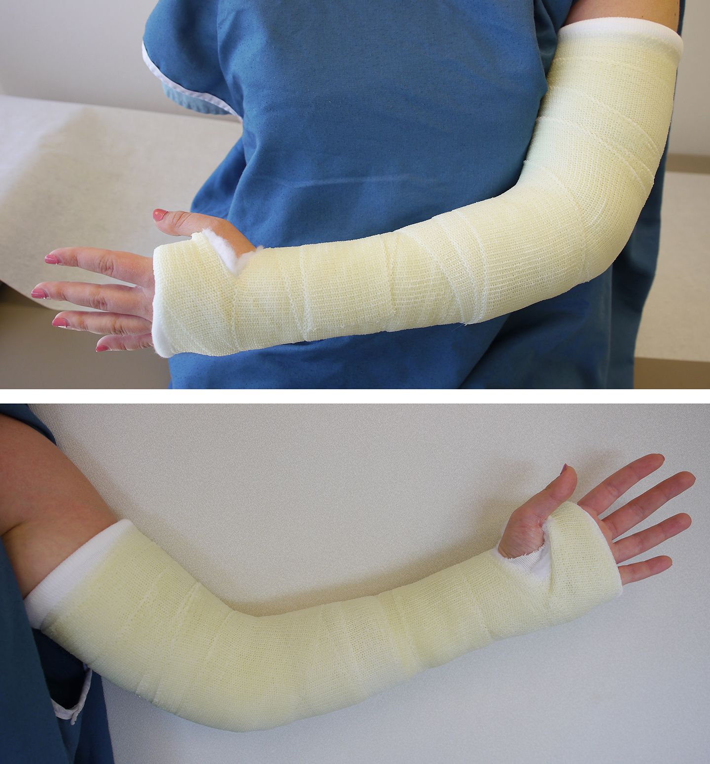 long arm cast