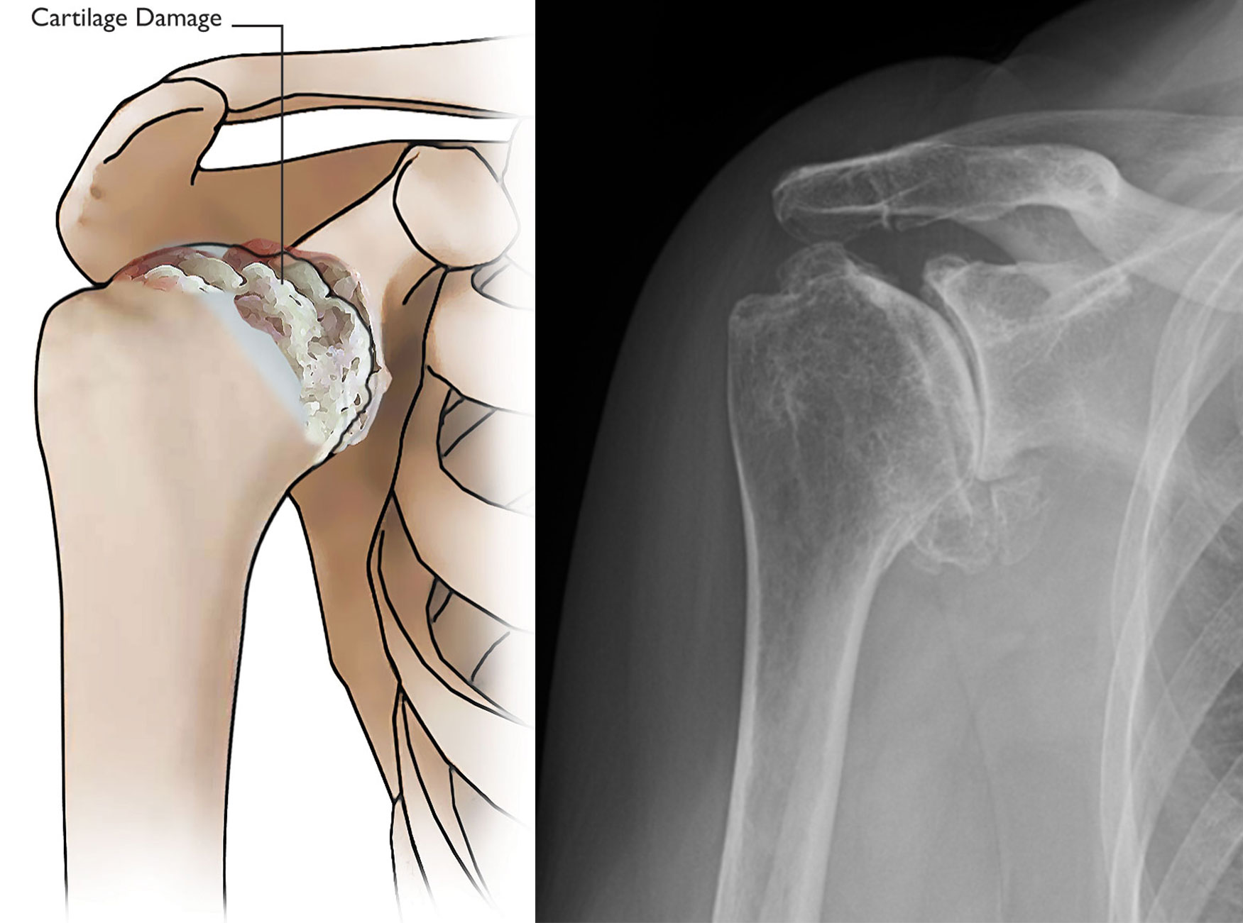 Osteoarthritis of the shoulder