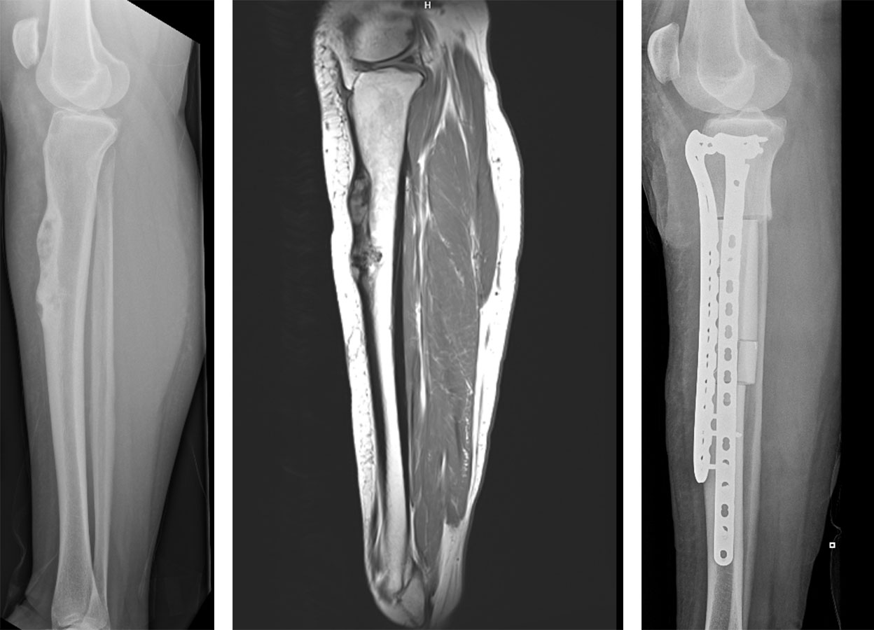 adamantinoma before and after limb salvage