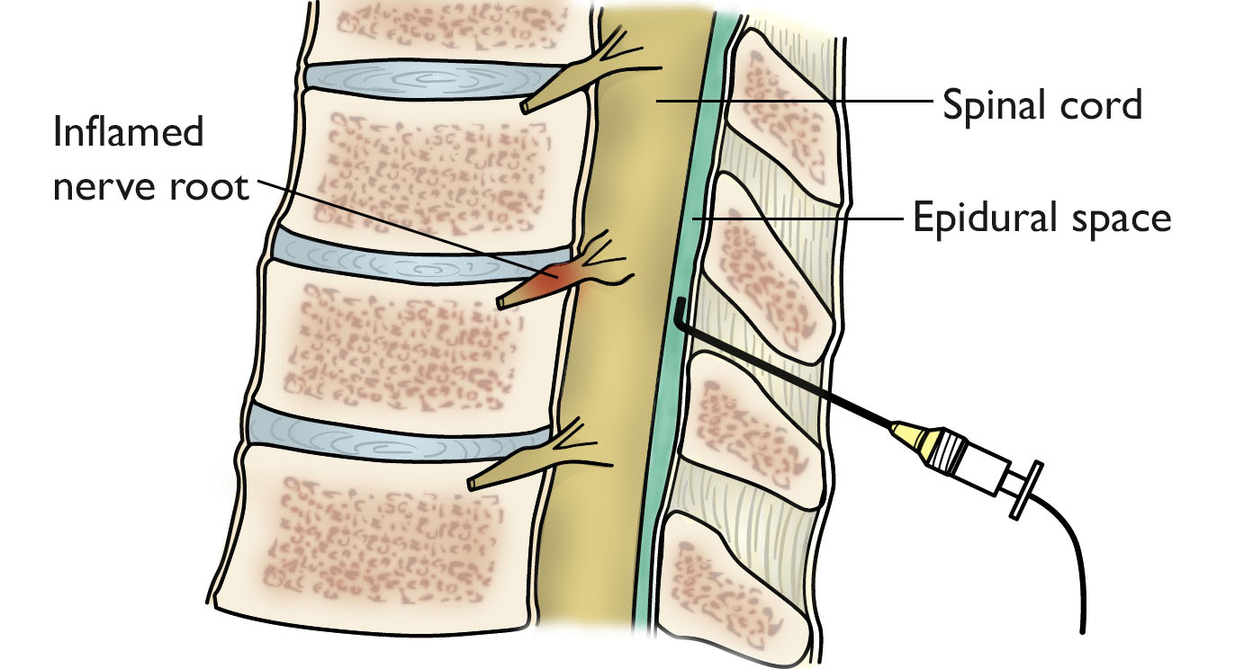 Illustration of Spinal Injection