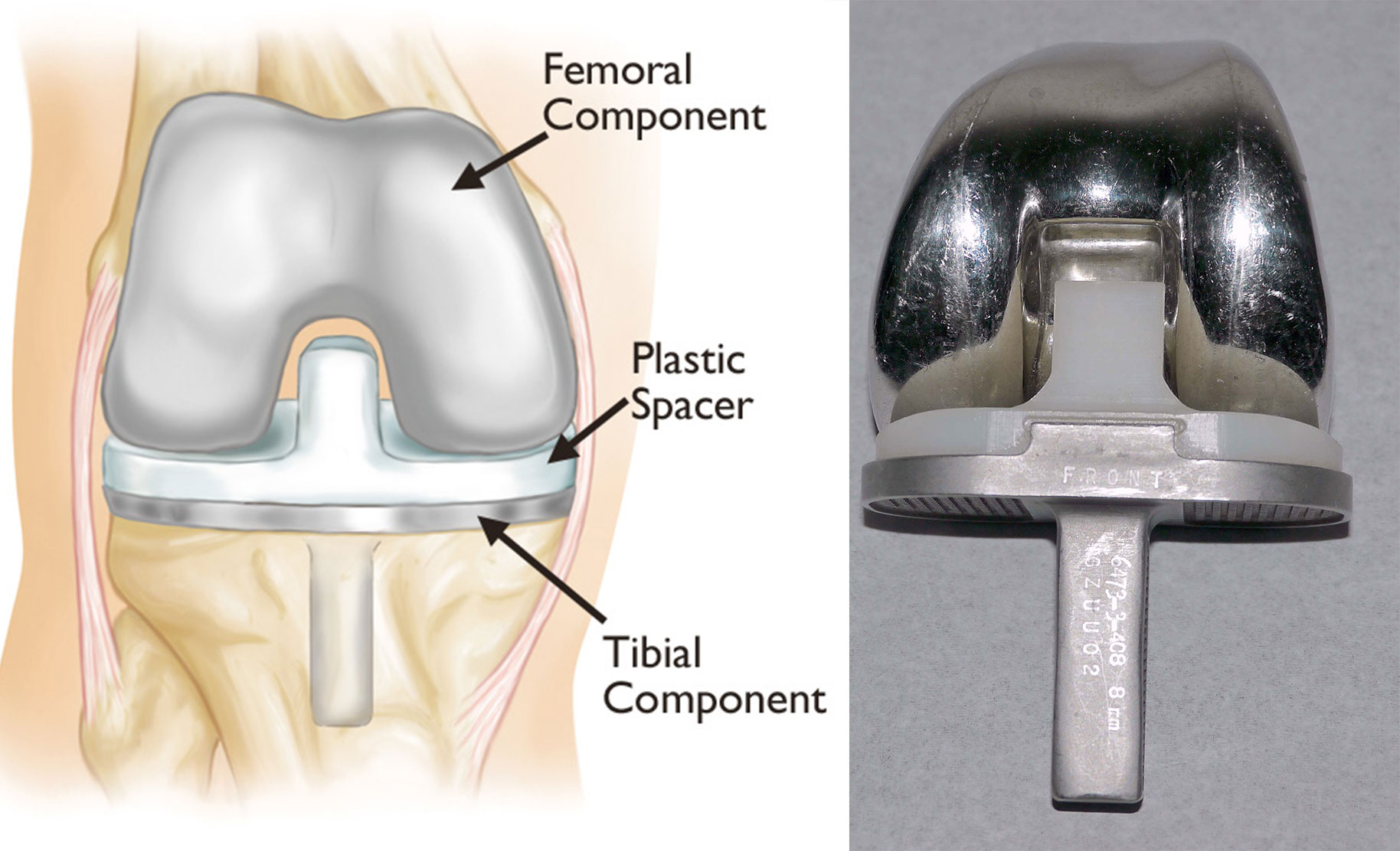 Illustration and photo showing total knee replacement implant