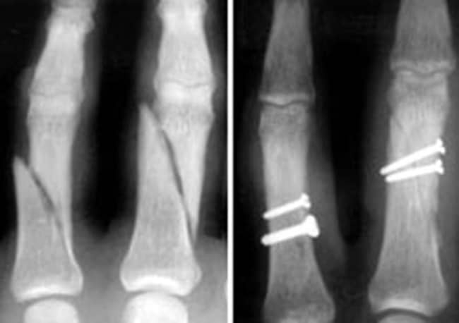 Fractured Phalanges Repaired With Screws