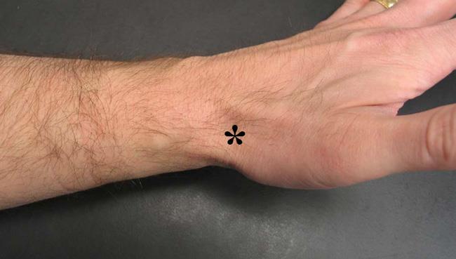 Anatomic snuffbox