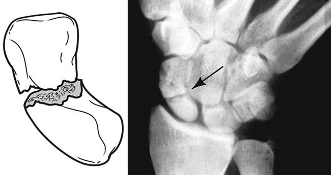 Scaphoid fracture