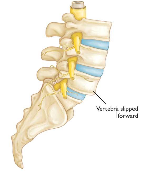 Spondylolisthesis