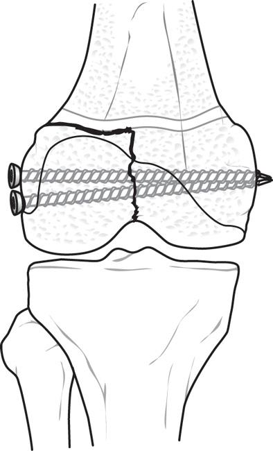 Internal fixation of growth plate fracture