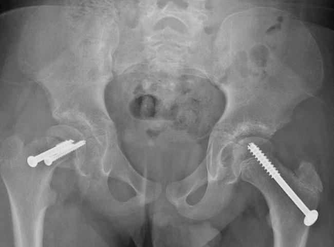 In situ fixation