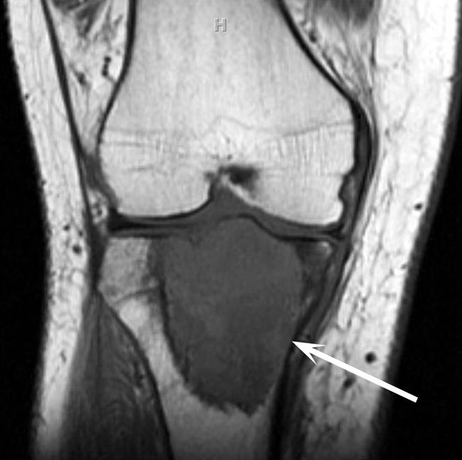 MRI scan of giant cell tumor