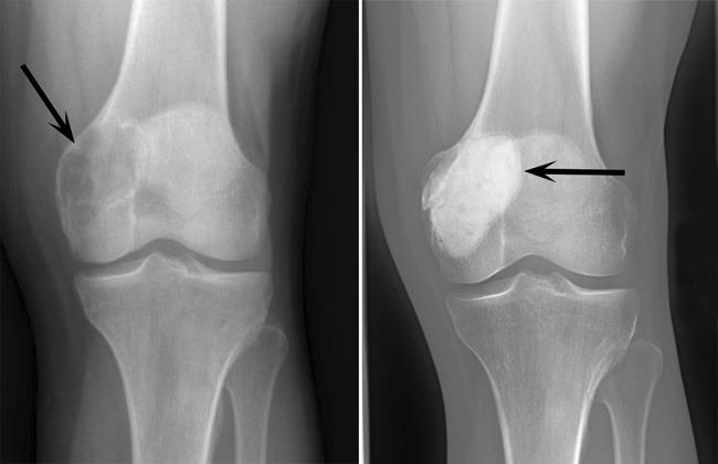Giant cell tumor before and after curettage
