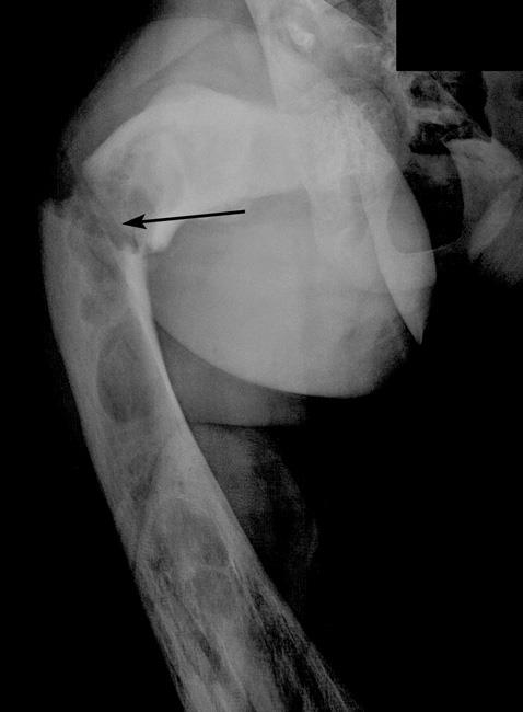 Fibrous dysplasia and pathologic fracture