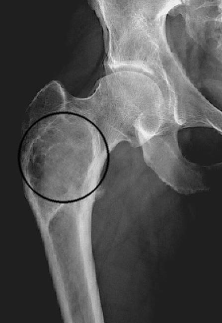 Ground glass appearance of fibrous dysplasia