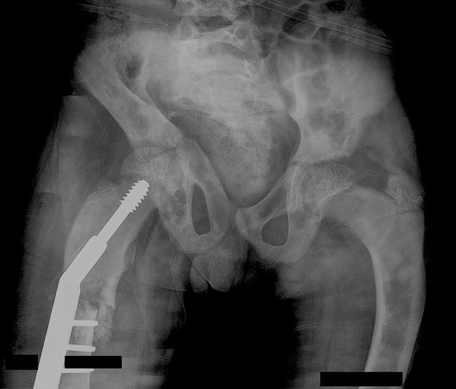 Internal fixation of pathologic fracture