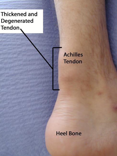 Achilles tendinitis