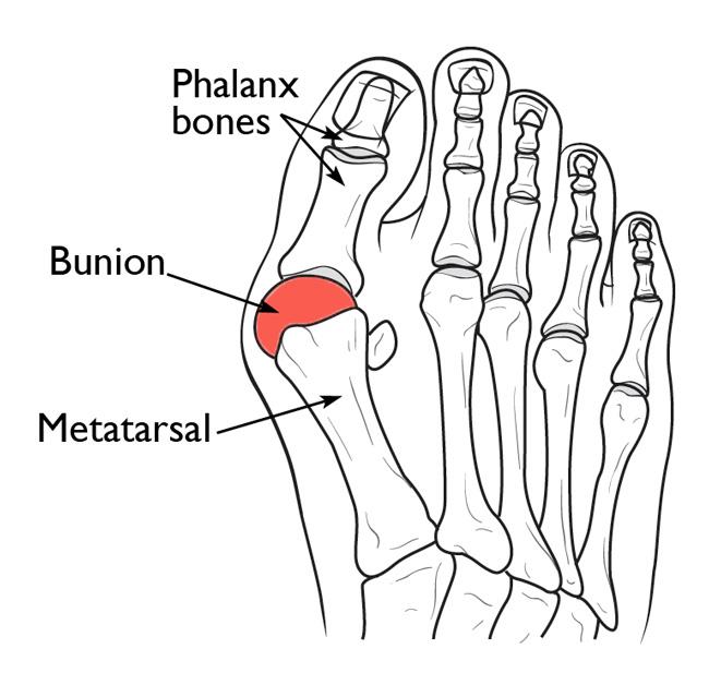 Inflammation of the MTP joint
