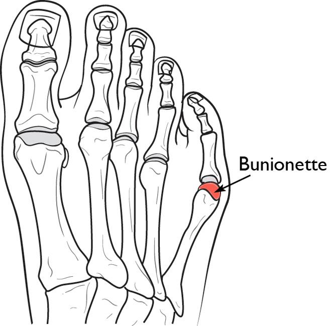 Bunionette