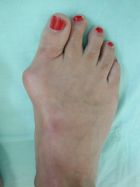 Large bunion