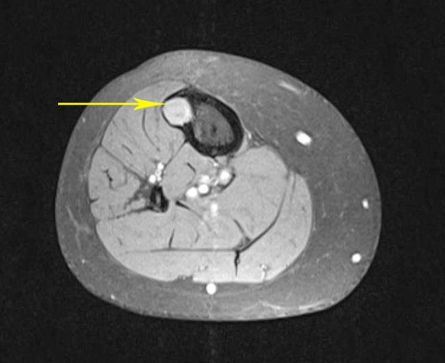 CT scan of bone tumor