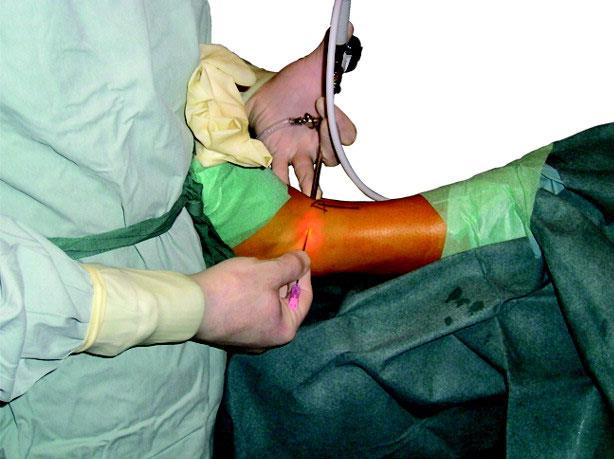 arthroscopic ankle surgery