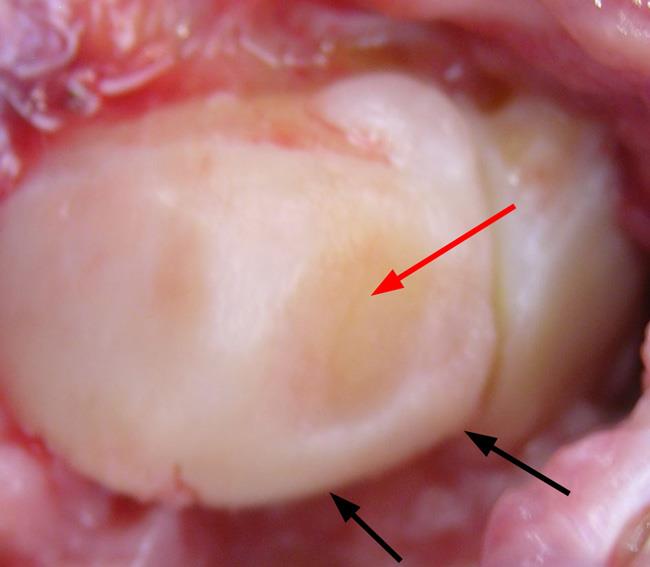 Surgical photo of the lunate bone in a patient with Kienböck's disease