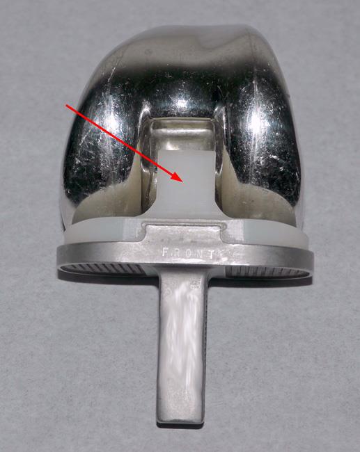 Posterior-stabilized component