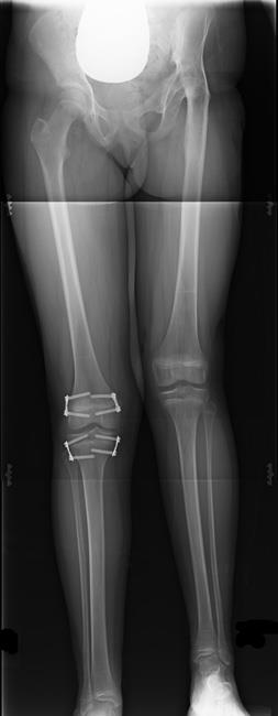 X-ray of epiphysiodesis