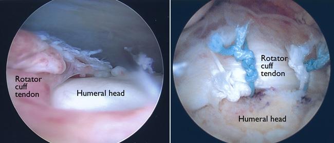 Arthroscopic photos of rotator cuff tear and repair