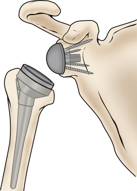 The components of a reverse total shoulder replacement