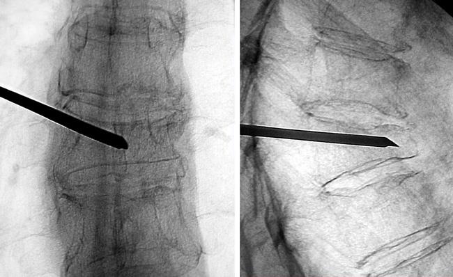 X-ray showing vertebroplasty