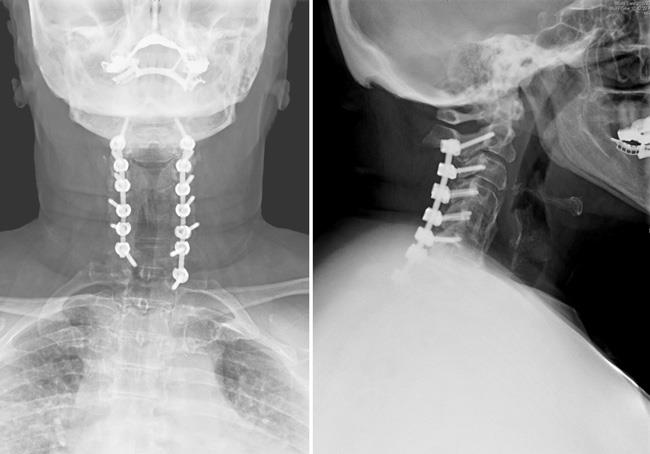 A posterior laminectomy and fusion from the front and side
