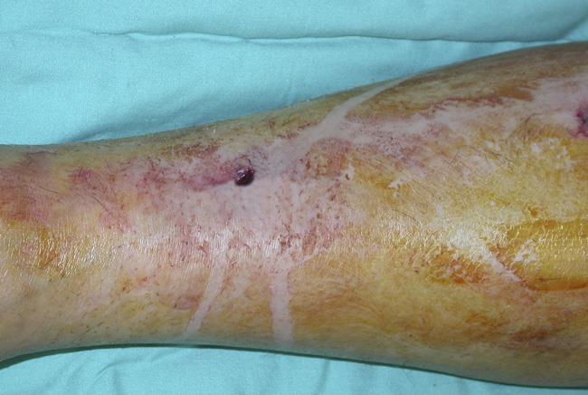 open wound over fracture
