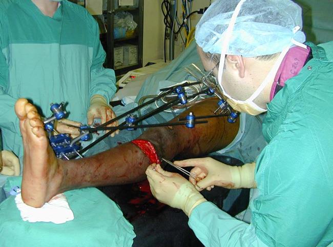 Doctor closes wound in severe open fracture