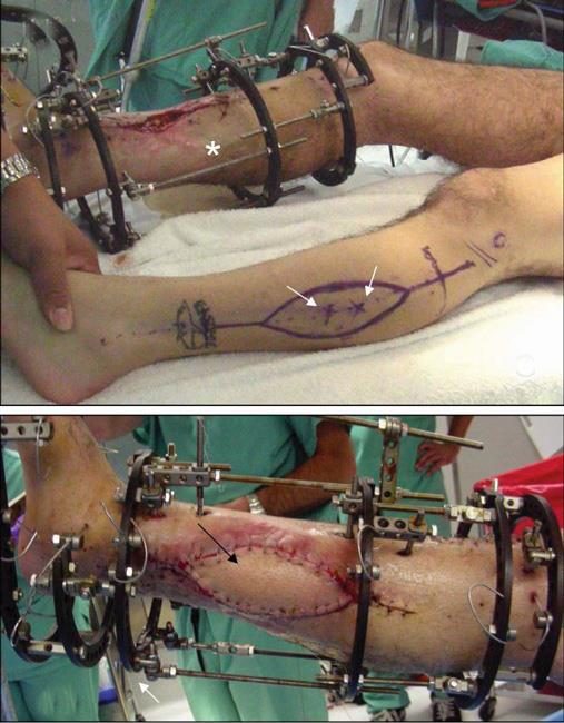 Flap technique to cover open wound