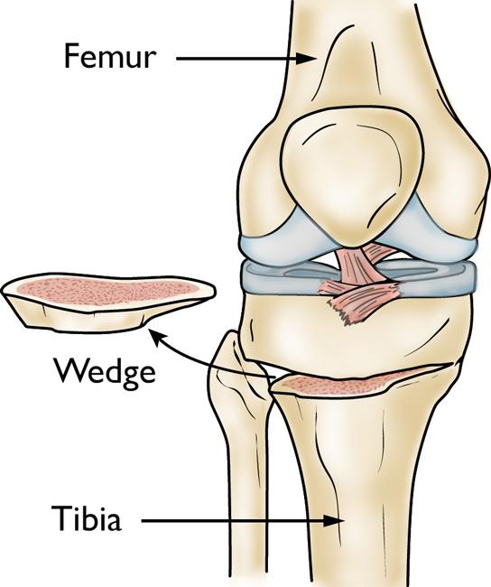 a tibial osteotomy