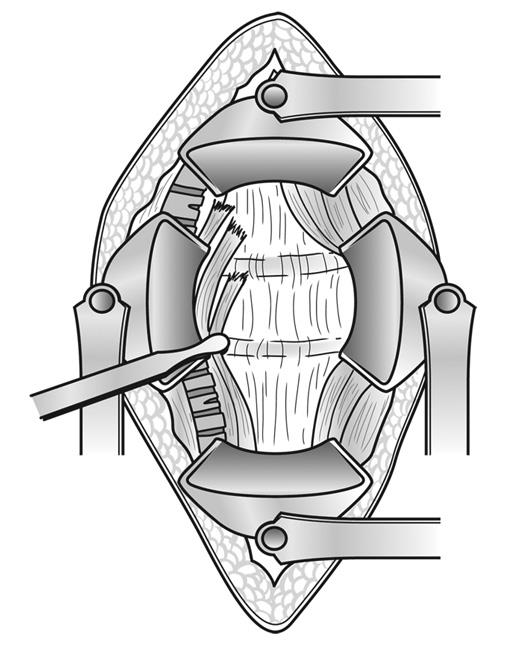anterior approach to spine surgery