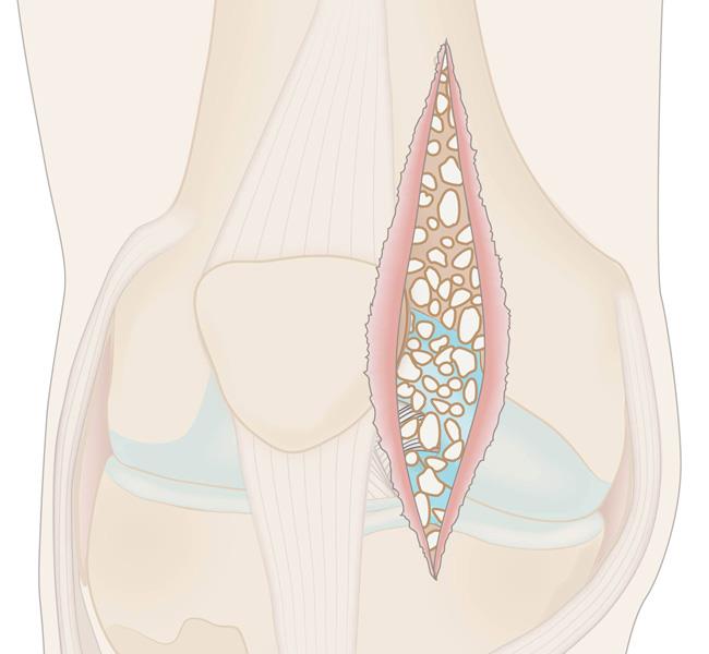 Illustration of traditional open procedure to remove loose bodies