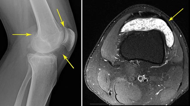 synovial chondromatosis x-ray and MRI scan