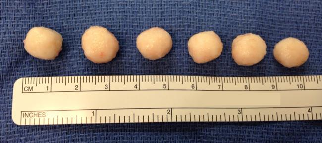 synovial chondromatosis calcified loose bodies