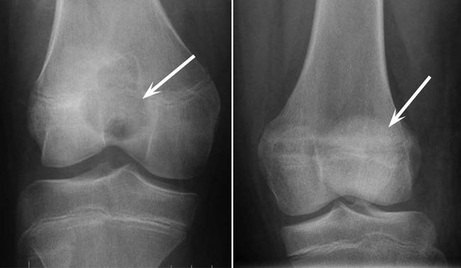 chondroblastoma x-ray pre- and post-treatment