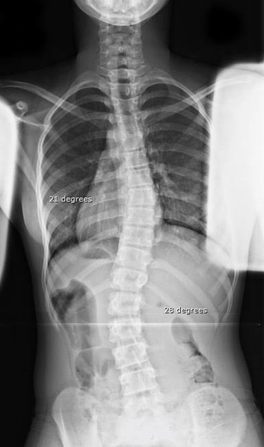 A 28° curve in an immature 12 yo girl