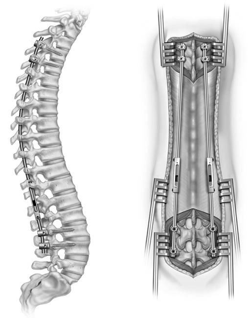Growing rods and neuromuscular scoliosis