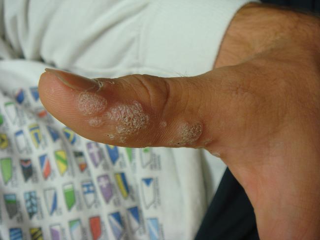 Warts