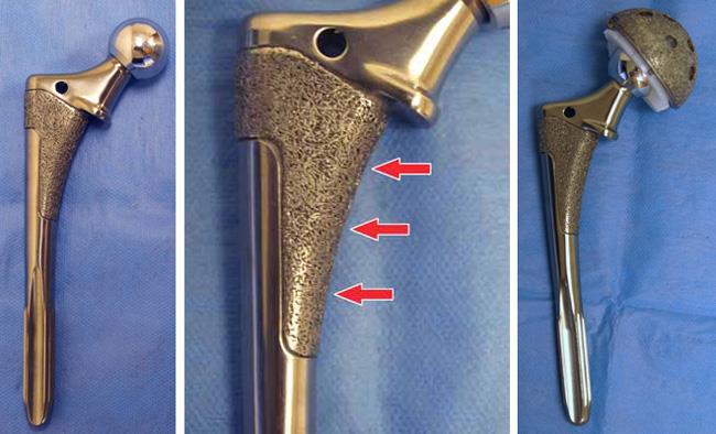 (Esquerda) Componente femoral não cimentado convencional. (Centro) Vista aproximada desse componente, mostrando a superfície porosa para a penetração do crescimento ósseo. (Direta) Componente femoral e componente acetabular trabalhando juntos. 