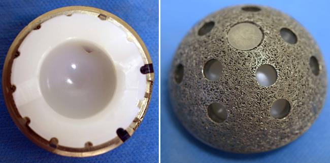 (Esquerda) O componente acetabular mostra a camada plástica (polietileno) no interior da concha metálica. (Direita) A superfície porosa deste componente acetabular permite a penetração do crescimento ósseo. Os orifícios em torno do receptáculo são usados se for necessário fixá-lo com parafusos na posição correta. 
