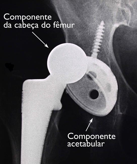 Deslocamento do implante de quadril. 