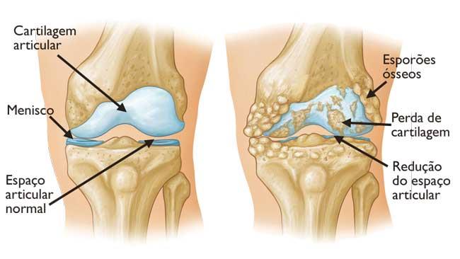 A osteoartrose resulta frequentemente no atrito entre os ossos. Esporões ósseos são uma manifestação comum dessa forma de artrite. 