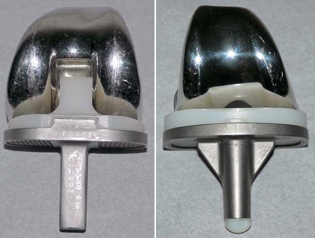 Diferentes tipos de implantes de joelho são usados para atender as necessidades de diferentes pacientes. 