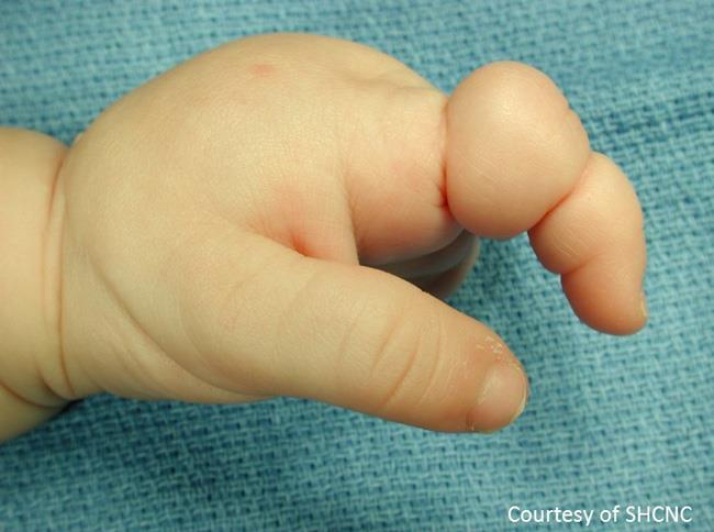  amniotic band syndrome (ABS)